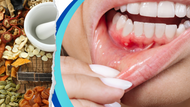 
 Ilustrasi 8 Menyembuhkan Sariawan dengan Keajaiban Herbal Alami